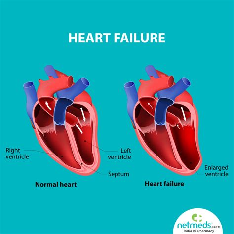 treatment for severe lv dysfunction